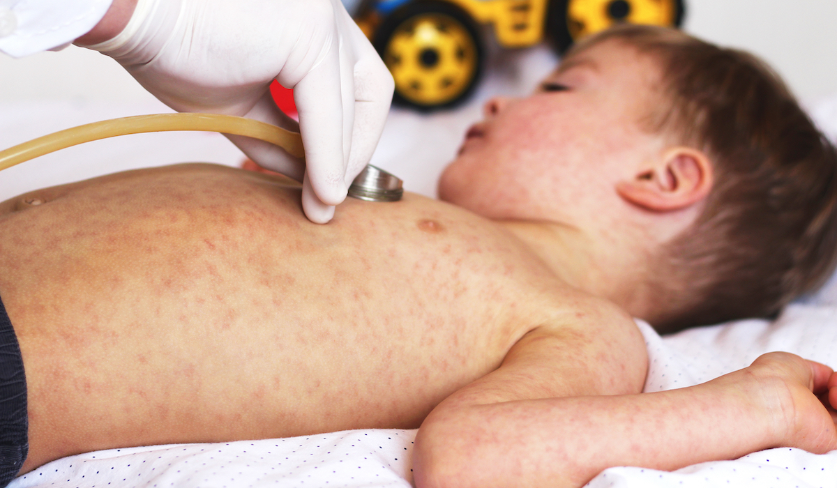 No, vitamin A does not prevent measles
