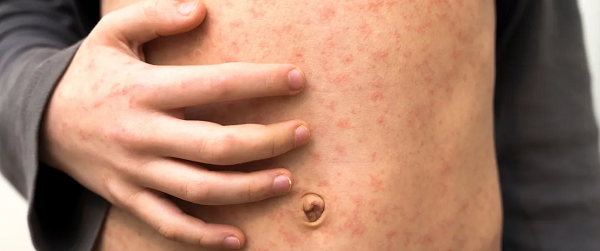 Volwassen persoon overleden aan mazelen