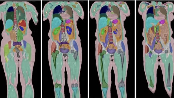 Biggest human imaging study scans 100,000th person | BBC