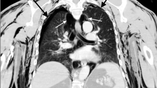 Images of the man's lungs