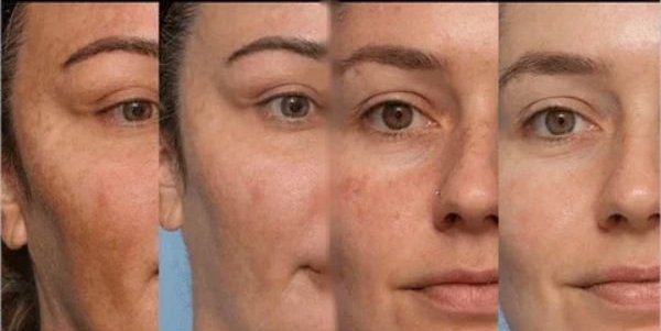 Melasma peeling mask