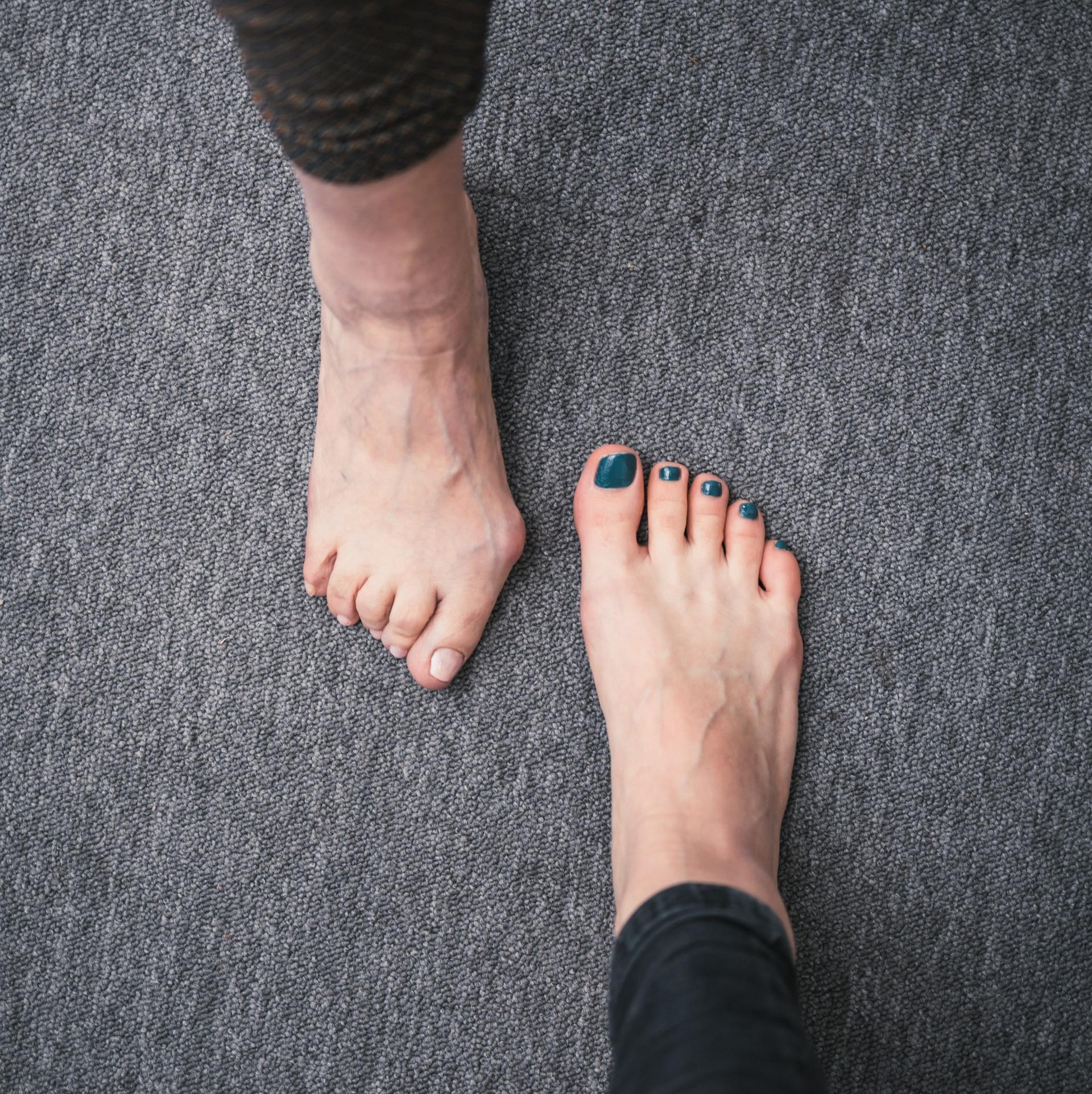 Porovnanie zdravého chodidla a chodidla s hallux valgus (vbočeným palcom)